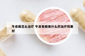 牛皮癣怎么治疗 牛皮有癣用什么药治疗效果好