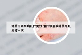 修美乐银屑病几针见效 治疗银屑病修美乐几周打一次