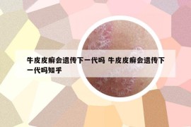 牛皮皮癣会遗传下一代吗 牛皮皮癣会遗传下一代吗知乎