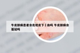 牛皮肤癣患者会出现皮下岀血吗 牛皮肤癣会蔓延吗