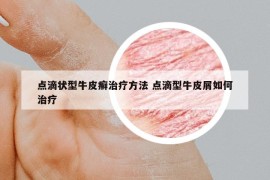 点滴状型牛皮癣治疗方法 点滴型牛皮屑如何治疗