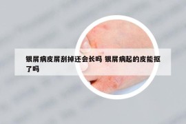 银屑病皮屑刮掉还会长吗 银屑病起的皮能抠了吗