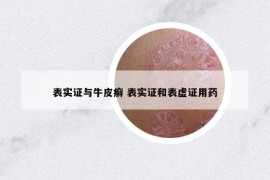 表实证与牛皮癣 表实证和表虚证用药