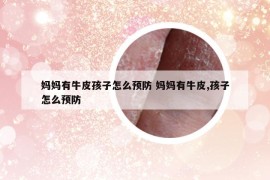 妈妈有牛皮孩子怎么预防 妈妈有牛皮,孩子怎么预防