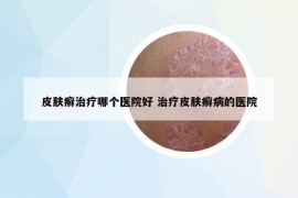 皮肤癣治疗哪个医院好 治疗皮肤癣病的医院