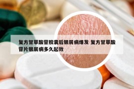 复方甘草酸苷胶囊后银屑病爆发 复方甘草酸苷片银屑病多久起效