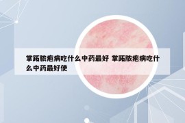 掌跖脓疱病吃什么中药最好 掌跖脓疱病吃什么中药最好使