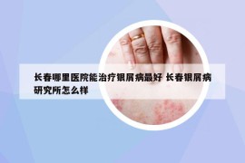 长春哪里医院能治疗银屑病最好 长春银屑病研究所怎么样