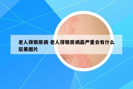 老人得银屑病 老人得银屑病最严重会有什么后果图片