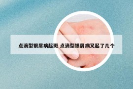 点滴型银屑病起斑 点滴型银屑病又起了几个