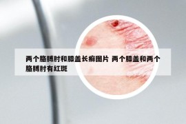 两个胳膊肘和膝盖长癣图片 两个膝盖和两个胳膊肘有红斑