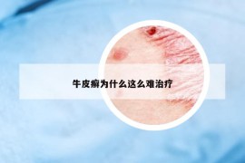 牛皮癣为什么这么难治疗