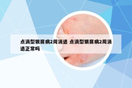 点滴型银屑病2周消退 点滴型银屑病2周消退正常吗