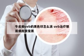 牛皮癣uvb的黑色印怎么消 uvb治疗银屑病皮肤变黑