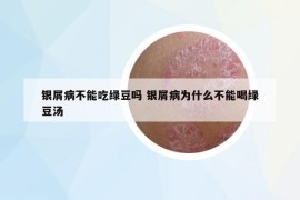 银屑病不能吃绿豆吗 银屑病为什么不能喝绿豆汤