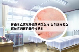 济南省立医院看银屑病怎么样 山东济南省立医院官网预约挂号皮肤科