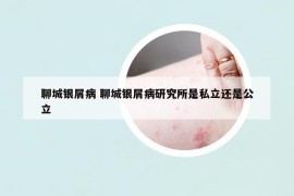 聊城银屑病 聊城银屑病研究所是私立还是公立