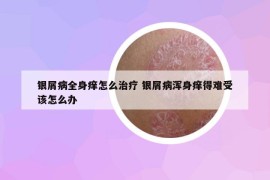 银屑病全身痒怎么治疗 银屑病浑身痒得难受该怎么办