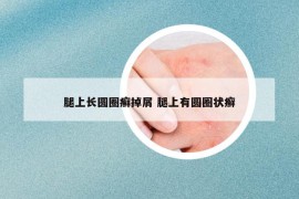 腿上长圆圈癣掉屑 腿上有圆圈状癣