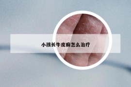 小孩长牛皮癣怎么治疗