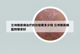 兰州银屑病治疗的价格要多少钱 兰州银屑病医院哪家好