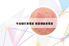 牛皮癣打青霉素 银屑病输青霉素