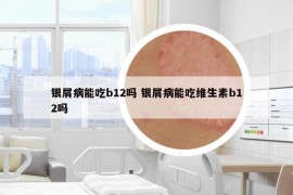 银屑病能吃b12吗 银屑病能吃维生素b12吗