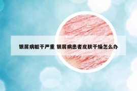 银屑病躯干严重 银屑病患者皮肤干燥怎么办