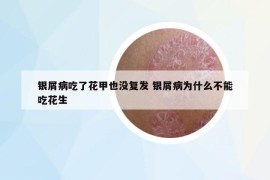 银屑病吃了花甲也没复发 银屑病为什么不能吃花生