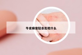 牛皮癣变轻会出现什么