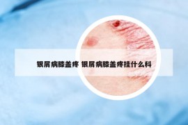 银屑病膝盖疼 银屑病膝盖疼挂什么科