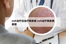 uvb治疗仪治疗银屑病 uvb治疗银屑病原理