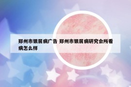 郑州市银屑病广告 郑州市银屑病研究会所看病怎么样