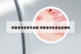 阿昔洛韦软膏牛皮癣 阿昔洛韦乳膏治皮癣吗