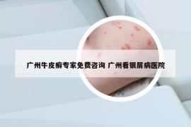 广州牛皮癣专家免费咨询 广州看银屑病医院