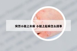 突然小腿上长癣 小腿上起癣怎么回事