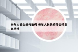 老年人长头癣传染吗 老年人长头癣传染吗怎么治疗