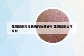 生物制剂对皮肤病的效果好吗 生物制剂治疗皮肤