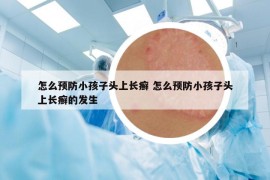 怎么预防小孩子头上长癣 怎么预防小孩子头上长癣的发生