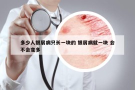 多少人银屑病只长一块的 银屑病就一块 会不会变多