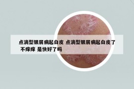 点滴型银屑病起白皮 点滴型银屑病起白皮了 不痒痒 是快好了吗