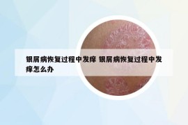 银屑病恢复过程中发痒 银屑病恢复过程中发痒怎么办