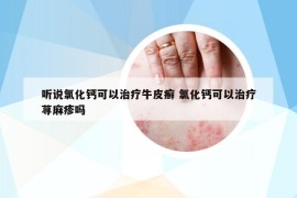 听说氯化钙可以治疗牛皮癣 氯化钙可以治疗荨麻疹吗