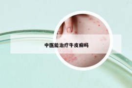 中医能治疗牛皮癣吗