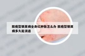 脓疱型银屑病全身红肿胀怎么办 脓疱型银屑病多久能消退