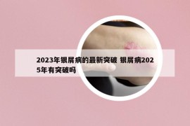 2023年银屑病的最新突破 银屑病2025年有突破吗