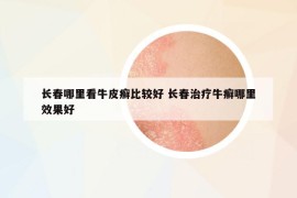 长春哪里看牛皮癣比较好 长春治疗牛癣哪里效果好