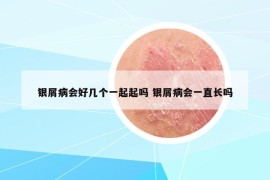 银屑病会好几个一起起吗 银屑病会一直长吗