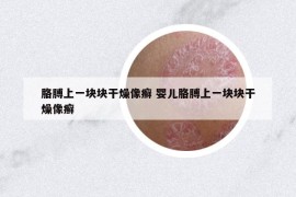 胳膊上一块块干燥像癣 婴儿胳膊上一块块干燥像癣