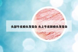 头部牛皮癣头发变白 头上牛皮肤癣头发变白